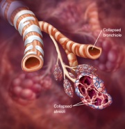 Illustration of airways affected by chronic bronchitis
