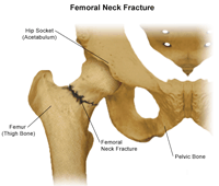 Fractured Hip Joint
