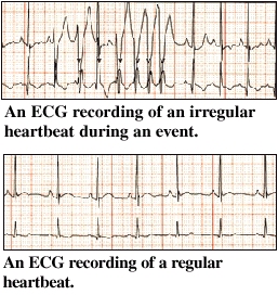 ECG recording
