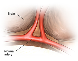 Closeup view of brain showing normal arteries.