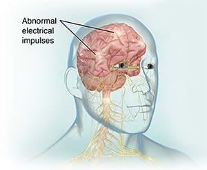 Front view of brain and spinal cord with abnormal brain activity.